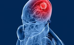 Brain-Tumour-Odisha