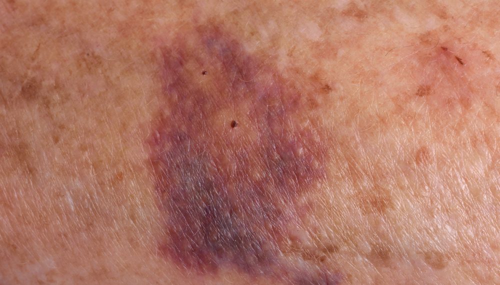 atopic-eczema-the-best-ways-to-deal-with-atopic-eczema-effective