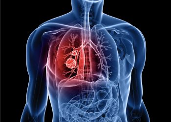 lung-cancer-odisha