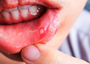 mouth-ulcer