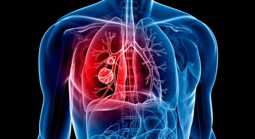 lung cancer AI