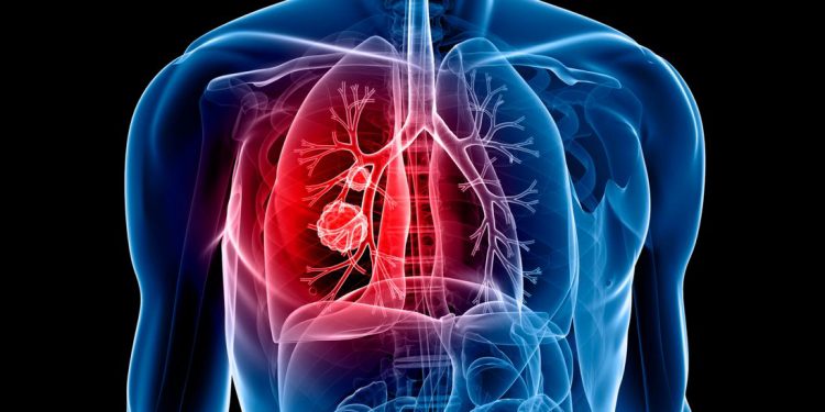 lung cancer AI