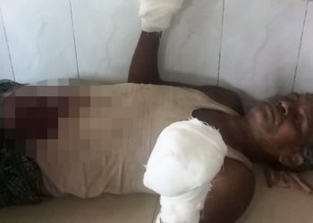 Man loses palms in firecracker explosion
