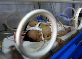 The twin boys shared a kidney and a pair of legs but had separate hearts and lungs (AFP)