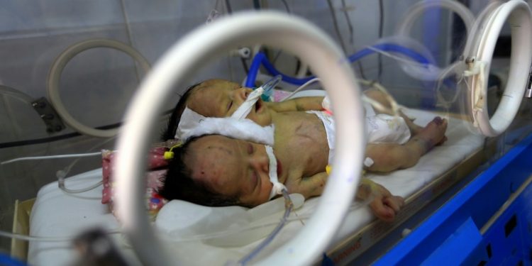 The twin boys shared a kidney and a pair of legs but had separate hearts and lungs (AFP)