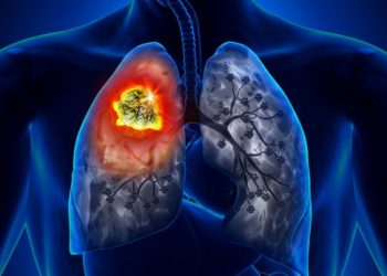 Researchers test AI tool that predicts risk of lung cancer