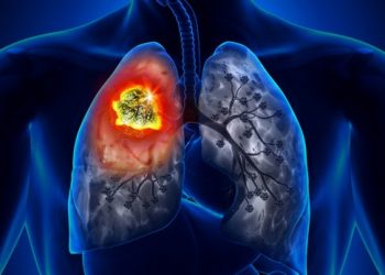Researchers test AI tool that predicts risk of lung cancer