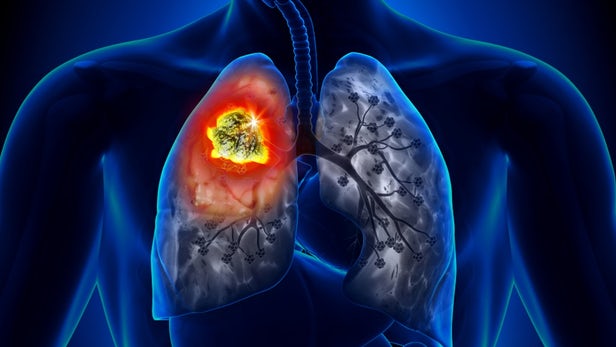 Researchers test AI tool that predicts risk of lung cancer