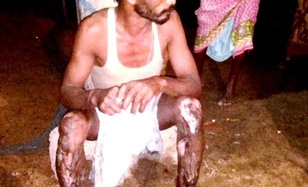 Man critically burnt as he walks on embers