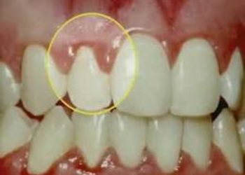 Poor oral health increases liver cancer risk