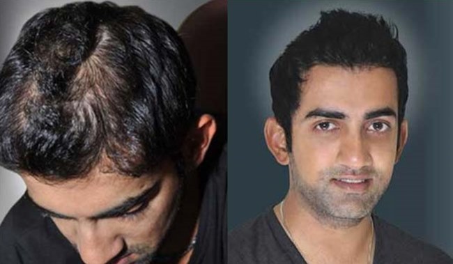 Indian cricketers who had hair transplants