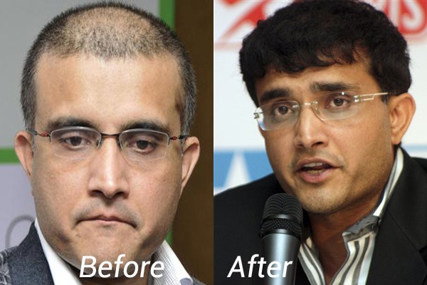 Indian cricketers who had hair transplants