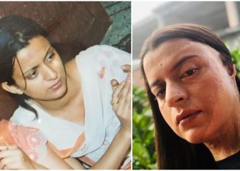 Kangana's sister Rangoli shares horrific details of acid attack