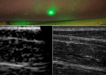 New laser system produces ultrasound images remotely