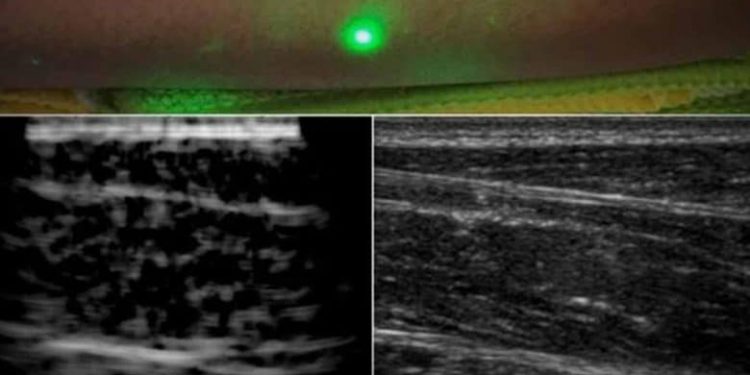 New laser system produces ultrasound images remotely