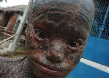 Ganjam’s 10-year-old boy nicknamed ‘human snake’ for rare skin disease
