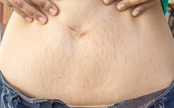 Home remedies to get rid of stubborn stretch marks on your body