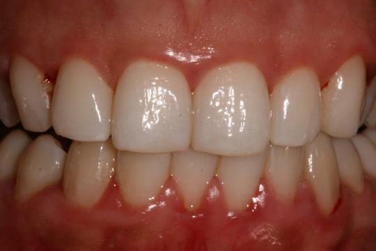 Effective Methods To Keep Gums Healthy Orissapost