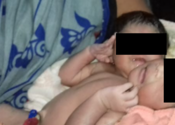 Twins with two heads, one body born in Kendrapara