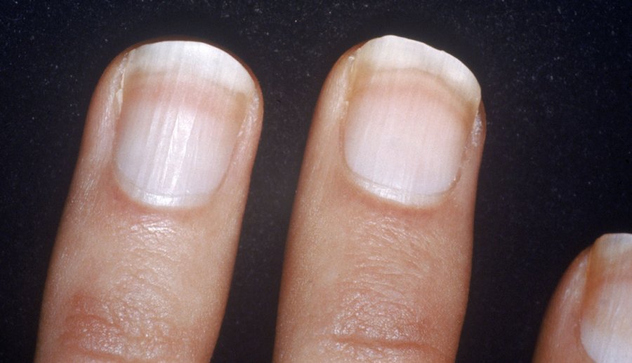 An Atlas of Nail Disorders, Part 8 | Consultant360