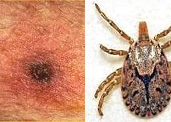 Scrub Typhus in Odisha