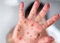 Germany reports first monkeypox case in a child