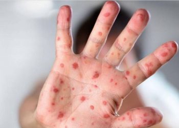 Monkeypox