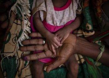 A woman holds the hands of her malnourished daughter inside a medical tent last year in the Tigray region of northern Ethiopia. (Ben Curtis / Associated Press via news.yahoo.com)