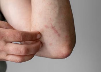 Urticaria: How to manage the skin disorder that affects 20% men