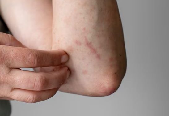 Urticaria: How to manage the skin disorder that affects 20% men