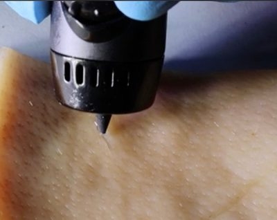 New wound-healing ink repairs cuts with a 3D-printing pen