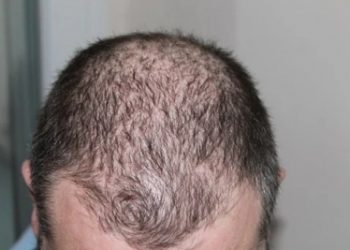 Hair loss in men