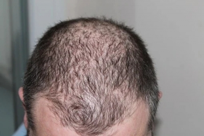 Hair loss in men