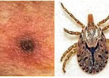 Scrub typhus cases rising