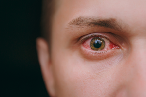 Human breast milk may heal this eye condition