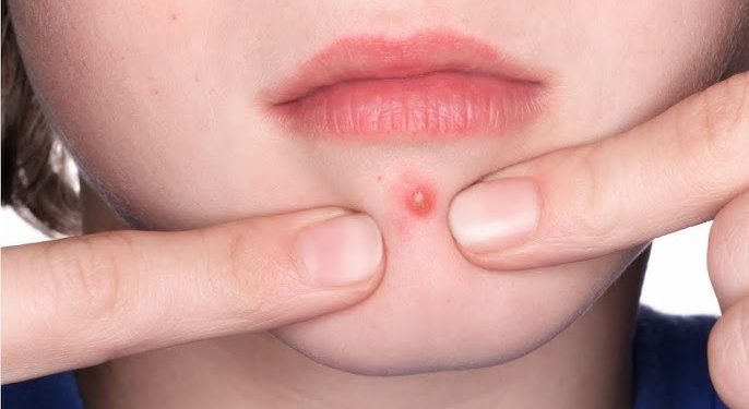 popping pimples