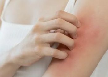Skin irritation