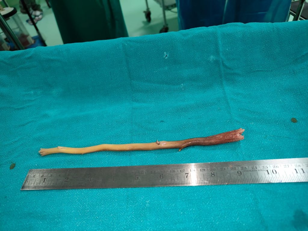 Doctors remove tooth stick from food pipe