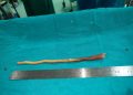Doctors remove tooth stick from food pipe