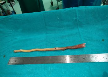Doctors remove tooth stick from food pipe