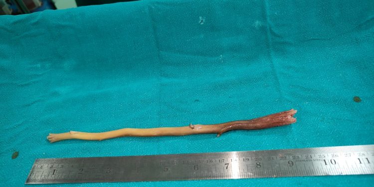 Doctors remove tooth stick from food pipe