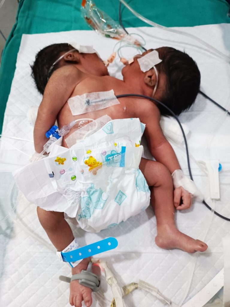 Conjoined baby boy born at MKCG