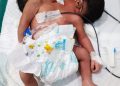 Conjoined baby boy born at MKCG