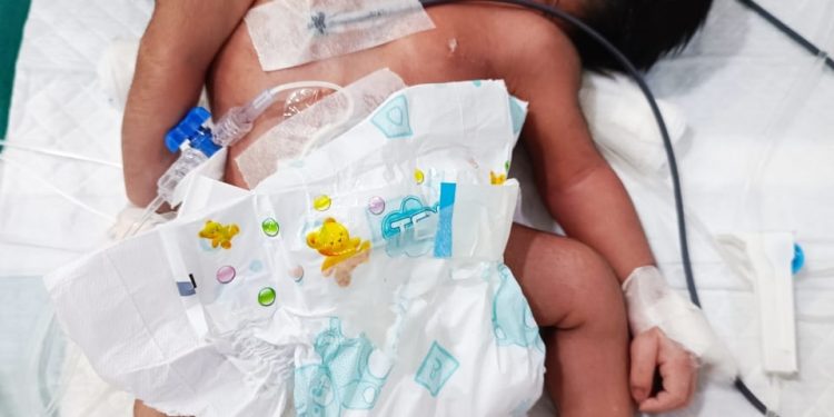 Conjoined baby boy born at MKCG